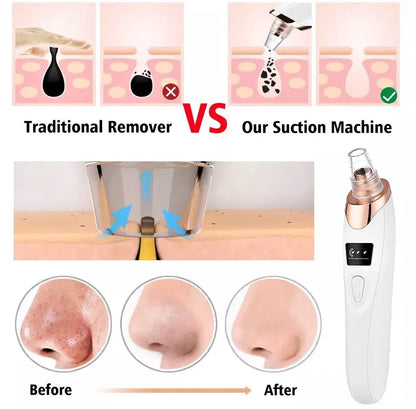 5in1 Blackhead Remover Machine Rechargeable